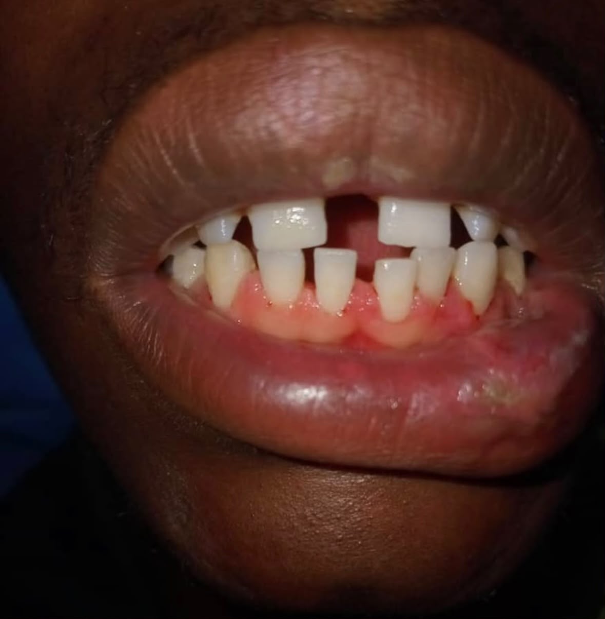 Bright Beam Clinical Case 4